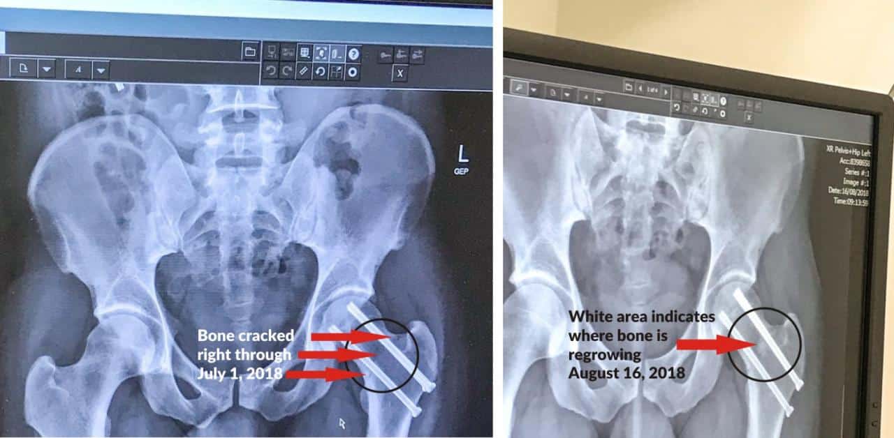 Dr Wallach Therapeutic Dosage for Bones