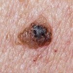 melanoma link to parasites